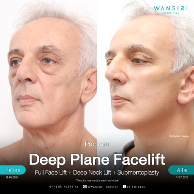 Deep Plane Facelift in Bangkok | Face Lift & Neck Lift | Wansiri Hospital
