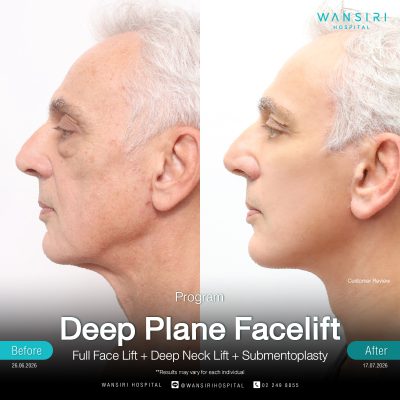 Deep Plane Facelift in Bangkok | Face Lift & Neck Lift | Wansiri Hospital