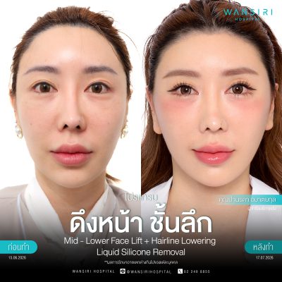 ดึงหน้า, ดึงหน้า ชั้นลึก, Face Lift, Deep Plane Facelift, Neck Lift