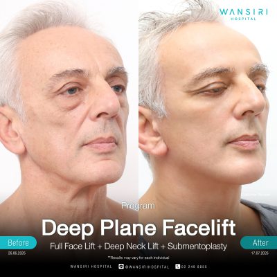 Deep Plane Facelift in Bangkok | Face Lift & Neck Lift | Wansiri Hospital