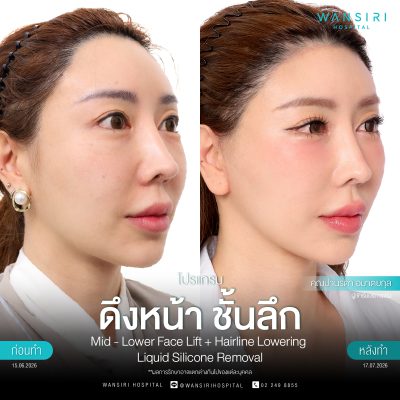 ดึงหน้า, ดึงหน้า ชั้นลึก, Face Lift, Deep Plane Facelift, Neck Lift
