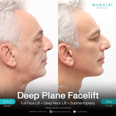 Deep Plane Facelift in Bangkok | Face Lift & Neck Lift | Wansiri Hospital