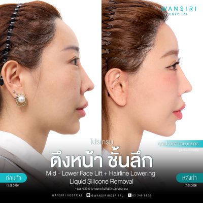 ดึงหน้า, ดึงหน้า ชั้นลึก, Face Lift, Deep Plane Facelift, Neck Lift