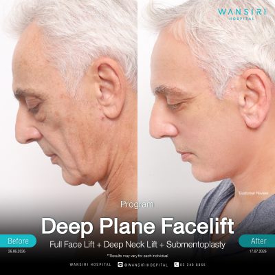 Deep Plane Facelift in Bangkok | Face Lift & Neck Lift | Wansiri Hospital