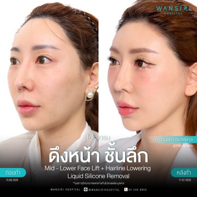 ดึงหน้า, ดึงหน้า ชั้นลึก, Face Lift, Deep Plane Facelift, Neck Lift