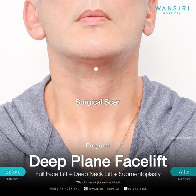 Deep Plane Facelift in Bangkok | Face Lift & Neck Lift | Wansiri Hospital