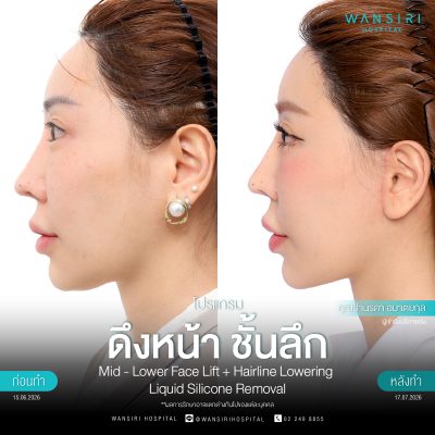ดึงหน้า, ดึงหน้า ชั้นลึก, Face Lift, Deep Plane Facelift, Neck Lift