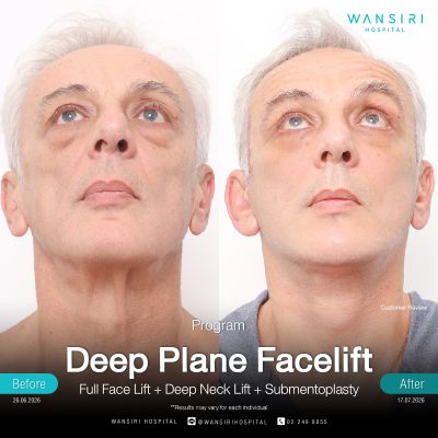 Deep Plane Facelift in Bangkok | Face Lift & Neck Lift | Wansiri Hospital