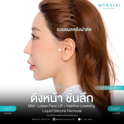 ดึงหน้า, ดึงหน้า ชั้นลึก, Face Lift, Deep Plane Facelift, Neck Lift
