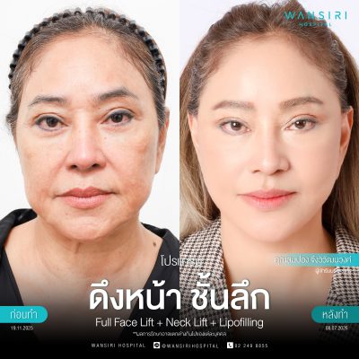 ดึงหน้า, ดึงหน้า ชั้นลึก, Face Lift, Deep Plane Facelift, Neck Lift
