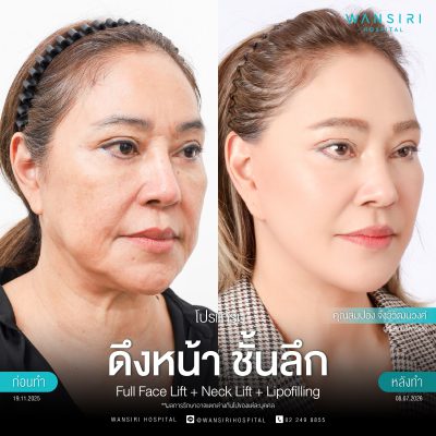 ดึงหน้า, ดึงหน้า ชั้นลึก, Face Lift, Deep Plane Facelift, Neck Lift