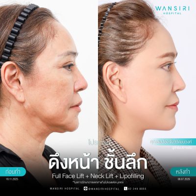 ดึงหน้า, ดึงหน้า ชั้นลึก, Face Lift, Deep Plane Facelift, Neck Lift