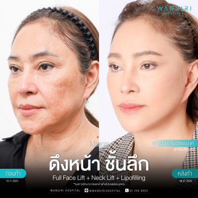 ดึงหน้า, ดึงหน้า ชั้นลึก, Face Lift, Deep Plane Facelift, Neck Lift