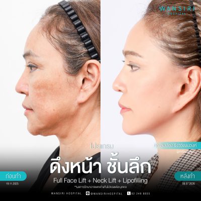 ดึงหน้า, ดึงหน้า ชั้นลึก, Face Lift, Deep Plane Facelift, Neck Lift