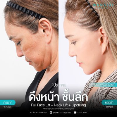 ดึงหน้า, ดึงหน้า ชั้นลึก, Face Lift, Deep Plane Facelift, Neck Lift