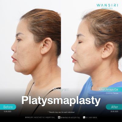 Platysmaplasty in Bangkok | Deep Plane Facelift & Face Lift | Wansiri Hospital