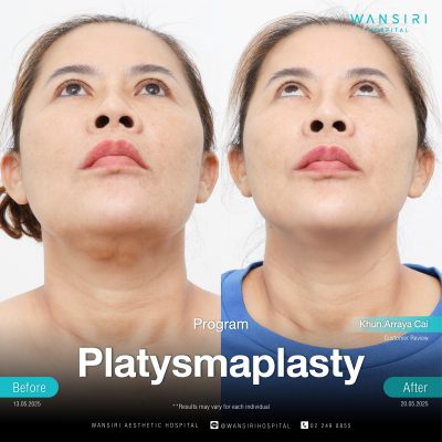 Platysmaplasty in Bangkok | Deep Plane Facelift & Face Lift | Wansiri Hospital