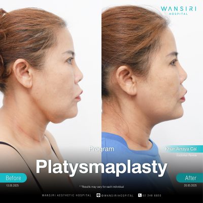 Platysmaplasty in Bangkok | Deep Plane Facelift & Face Lift | Wansiri Hospital