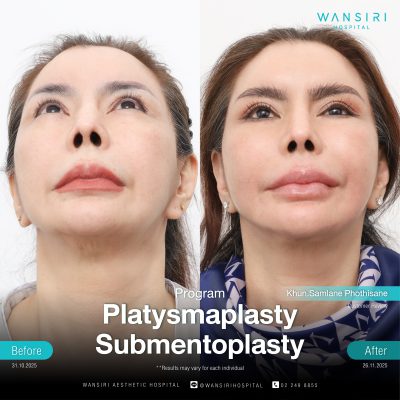 Submentoplasty in Bangkok | Enhance Your Jawline with Deep Plane Facelift & Neck Lift | Wansiri Hospital