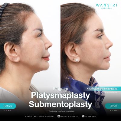 Submentoplasty in Bangkok | Enhance Your Jawline with Deep Plane Facelift & Neck Lift | Wansiri Hospital