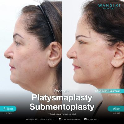 Submentoplasty in Bangkok | Enhance Your Jawline with Deep Plane Facelift & Neck Lift | Wansiri Hospital