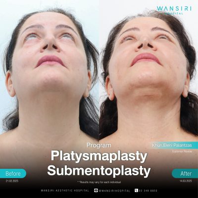 Submentoplasty in Bangkok | Enhance Your Jawline with Deep Plane Facelift & Neck Lift | Wansiri Hospital