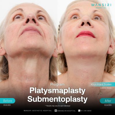 Submentoplasty in Bangkok | Enhance Your Jawline with Deep Plane Facelift & Neck Lift | Wansiri Hospital