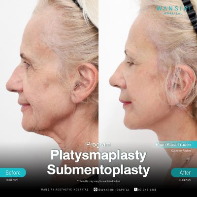 Submentoplasty in Bangkok | Enhance Your Jawline with Deep Plane Facelift & Neck Lift | Wansiri Hospital