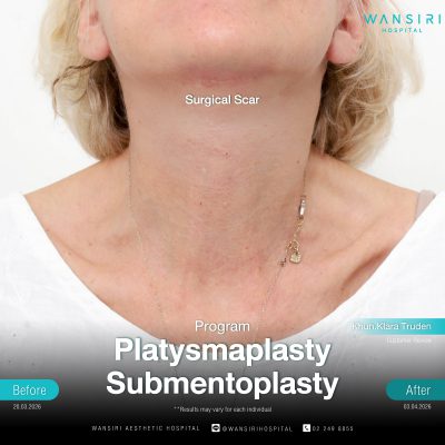 Submentoplasty in Bangkok | Enhance Your Jawline with Deep Plane Facelift & Neck Lift | Wansiri Hospital
