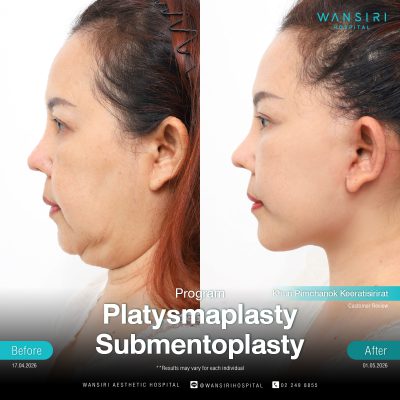 Submentoplasty in Bangkok | Enhance Your Jawline with Deep Plane Facelift & Neck Lift | Wansiri Hospital