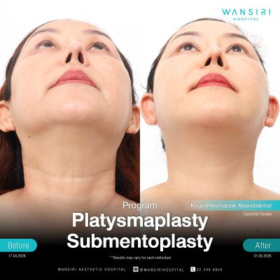 Submentoplasty in Bangkok | Enhance Your Jawline with Deep Plane Facelift & Neck Lift | Wansiri Hospital