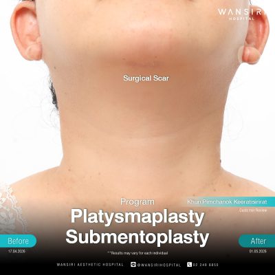 Platysmaplasty in Bangkok | Deep Plane Facelift & Face Lift | Wansiri Hospital