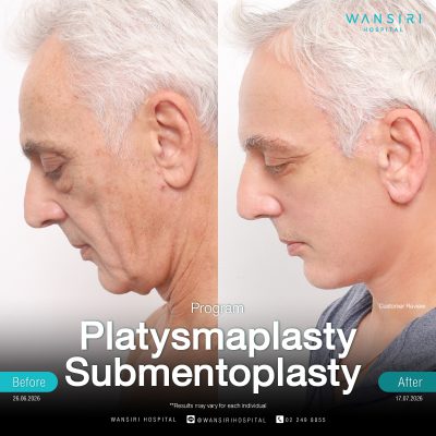 Submentoplasty in Bangkok | Enhance Your Jawline with Deep Plane Facelift & Neck Lift | Wansiri Hospital