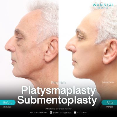 Submentoplasty in Bangkok | Enhance Your Jawline with Deep Plane Facelift & Neck Lift | Wansiri Hospital