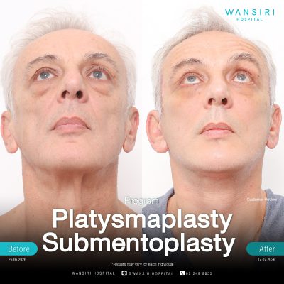 Submentoplasty in Bangkok | Enhance Your Jawline with Deep Plane Facelift & Neck Lift | Wansiri Hospital