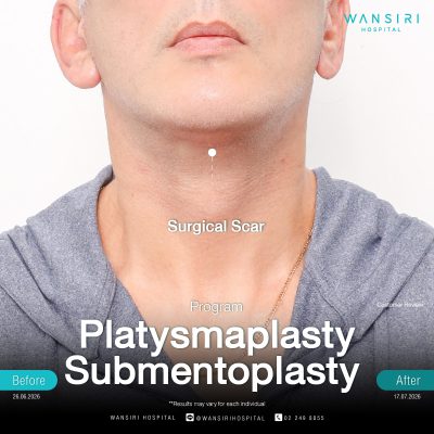 Submentoplasty in Bangkok | Enhance Your Jawline with Deep Plane Facelift & Neck Lift | Wansiri Hospital