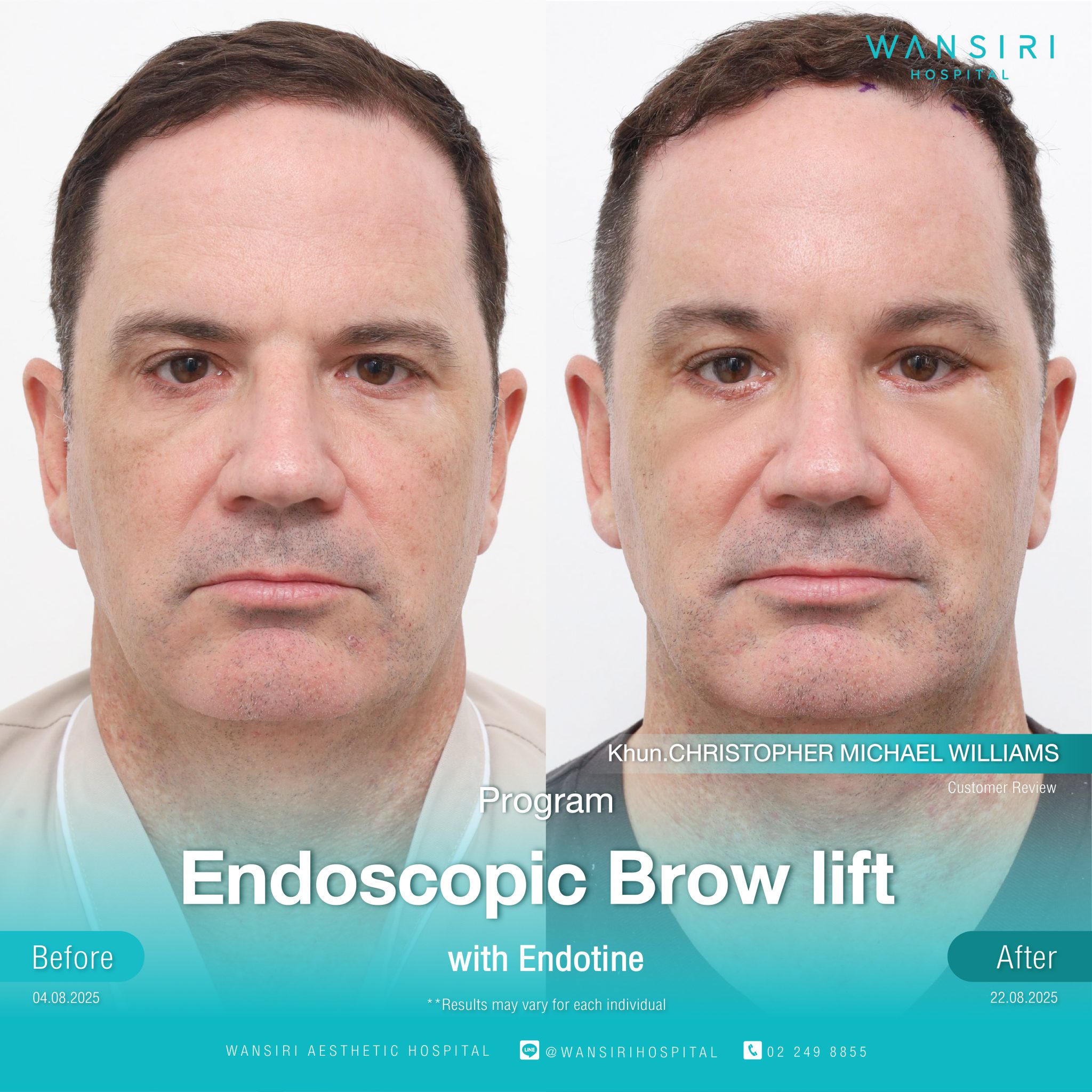 Endoscopic Brow Lift before and after results at Wansiri Hospital Bangkok