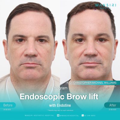 Endoscopic Brow Lift before and after results at Wansiri Hospital Bangkok