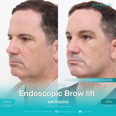 Endoscopic Brow Lift before and after results at Wansiri Hospital Bangkok