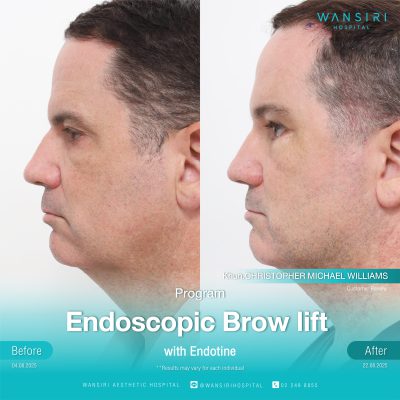 Endoscopic Brow Lift before and after results at Wansiri Hospital Bangkok