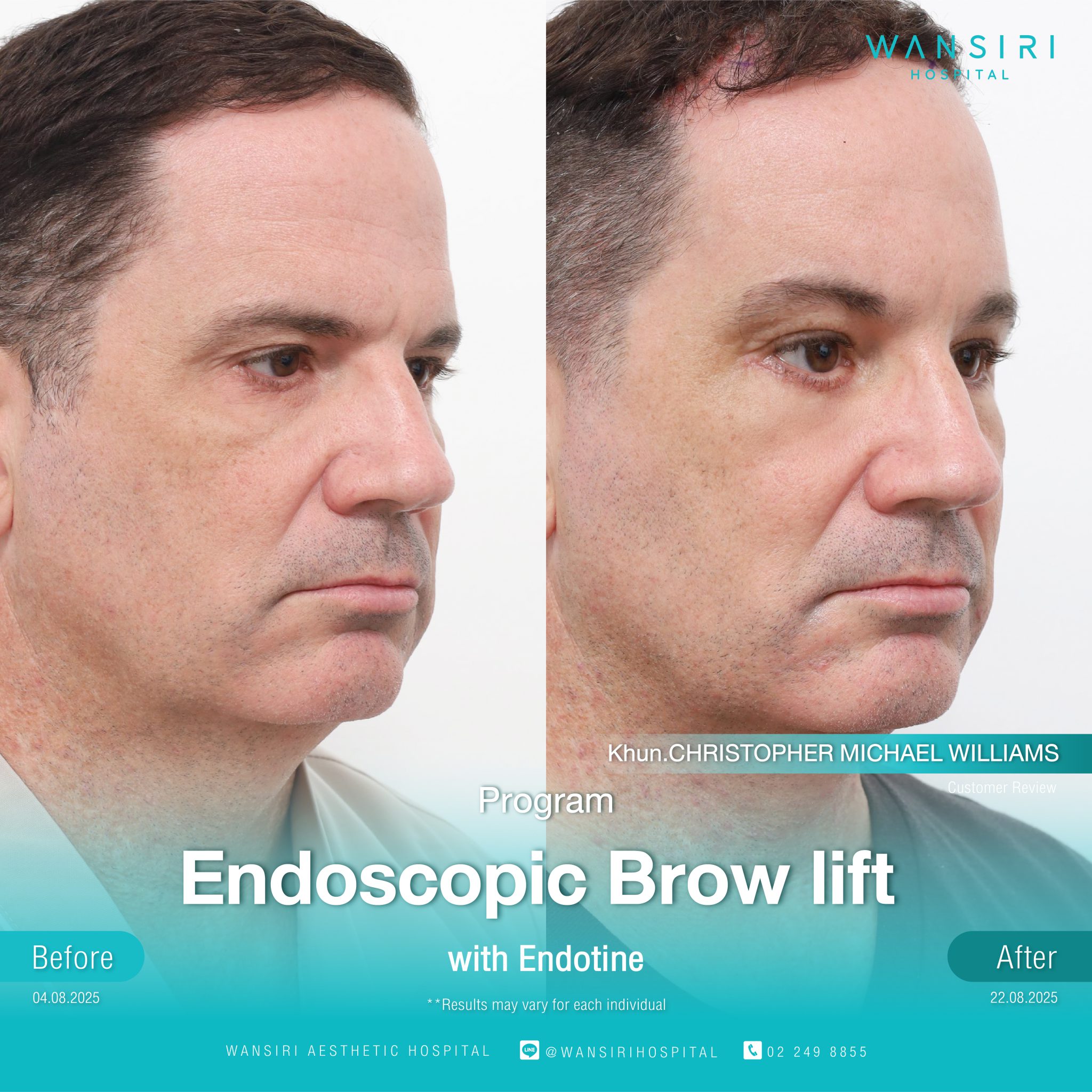 Endoscopic Brow Lift before and after results at Wansiri Hospital Bangkok
