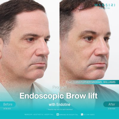 Endoscopic Brow Lift before and after results at Wansiri Hospital Bangkok