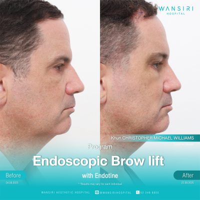 Endoscopic Brow Lift before and after results at Wansiri Hospital Bangkok