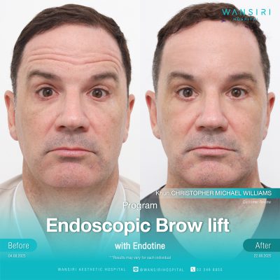 Endoscopic Brow Lift before and after results at Wansiri Hospital Bangkok