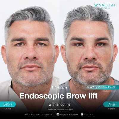 Endoscopic Brow Lift before and after results at Wansiri Hospital Bangkok