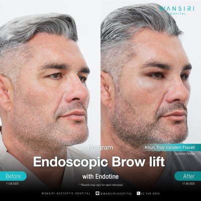 Endoscopic Brow Lift before and after results at Wansiri Hospital Bangkok