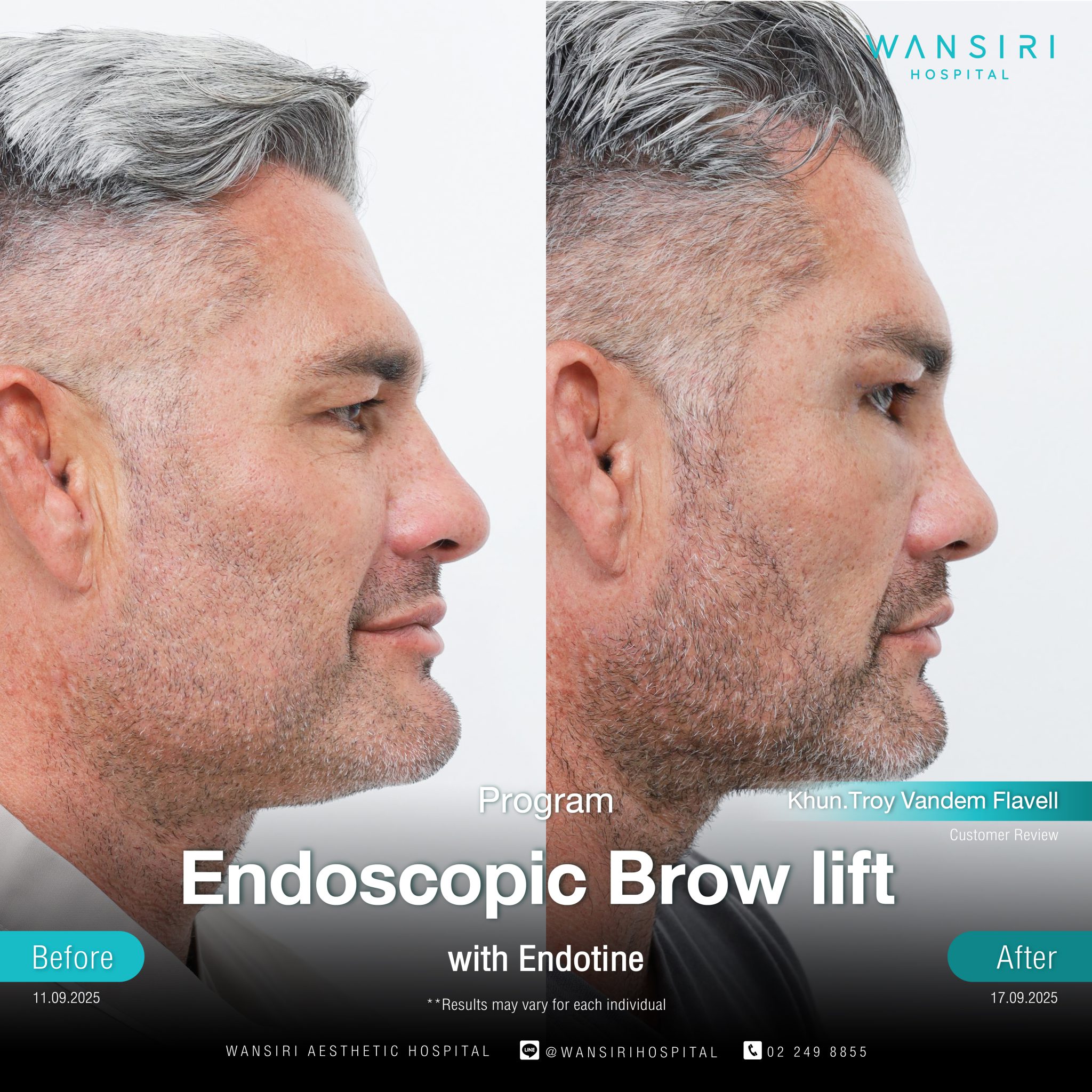 Endoscopic Brow Lift before and after results at Wansiri Hospital Bangkok