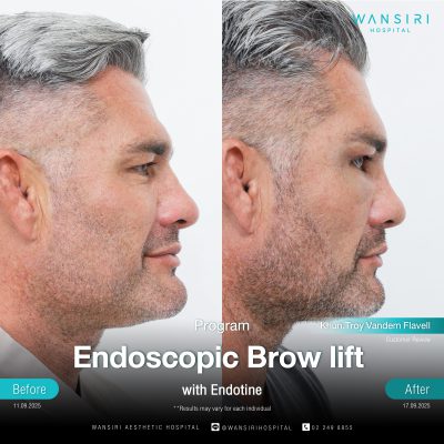 Endoscopic Brow Lift before and after results at Wansiri Hospital Bangkok
