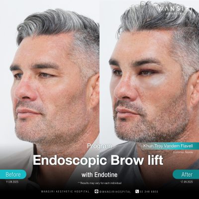Endoscopic Brow Lift before and after results at Wansiri Hospital Bangkok