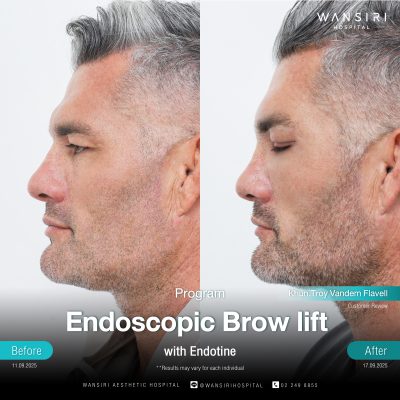 Endoscopic Brow Lift before and after results at Wansiri Hospital Bangkok